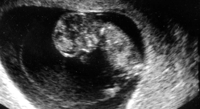 Ultraschall bei Verdacht auf Fehlgeburt