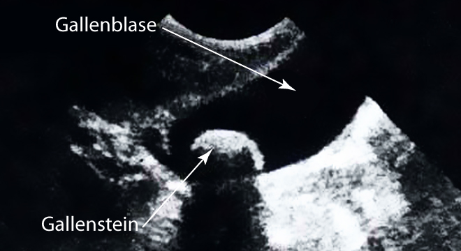 Gallensteine: Ultraschall oder Endoskopie