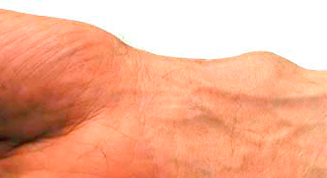 Ganglion: Schmerzen bei Druck, Zug oder Bewegung