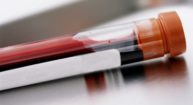 FSME (Frühsommer-Meningoenzephalitis): Antikörpernachweis im Blut