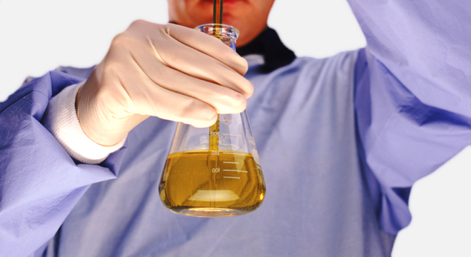 Glomerulonephritis: Blut und Eiweiss im Urin