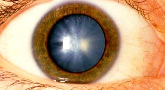 Grauer Star: von Auge erkennbar