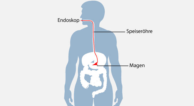 Helicobacter pylori-Infektion: Magenspiegelung und Gewebsentnahme