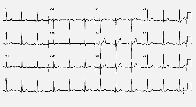 Herzinfarkt: Elektrokardiogramm (EKG)
