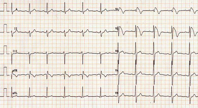 Herzrhythmusstörungen: EKG in Ruhe und unter Belastung