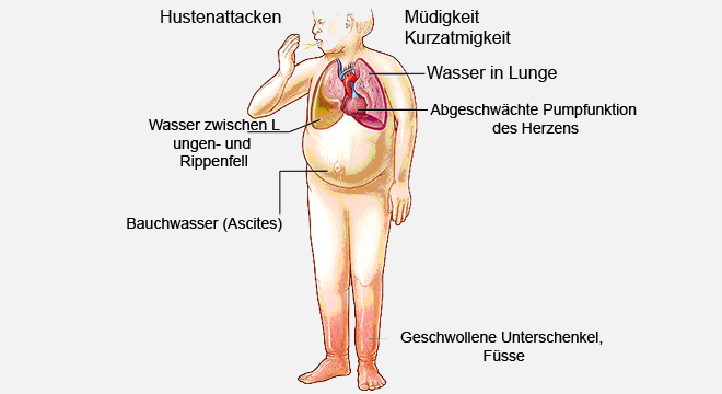 Herzinsuffizienz: Die Beschwerden hängen von der Form der Herzschwäche ab