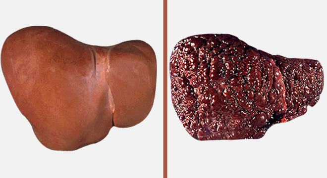 Leberschrumpfung: Links gesunde Leber, rechts kranke Leber
