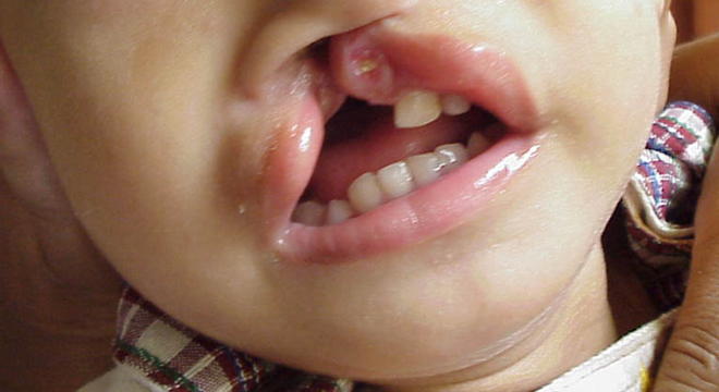 Lippen-, Kiefer- und/oder Gaumenspalten sind angeboren