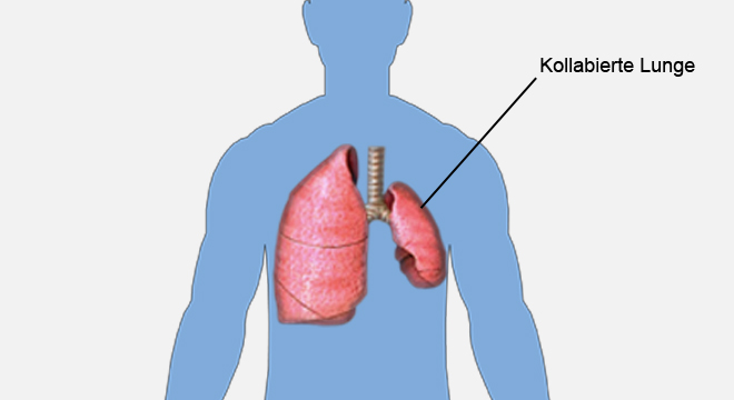Pneumothorax: Wenn Luft in den Spalt zwischen den Lungenfellen dringt.
