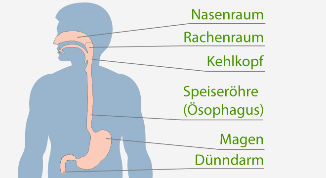 Zwerchfellbruch: häufig ist ein Zurückfliessen des Magensaftes mit saurem Aufstossen