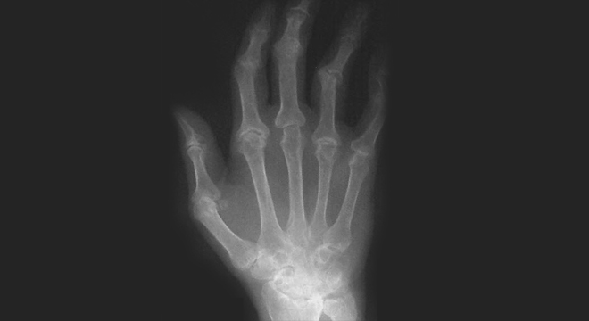 Rheuma: Deformationen im Röntgenbild