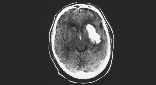 Schlaganfall: Computertomographie MRI