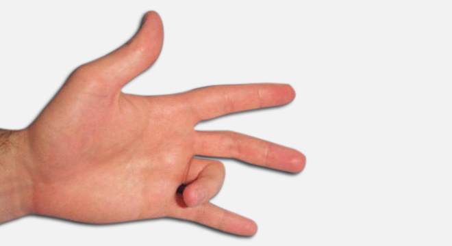 Schnellender Finger: Beugestellung und Streckstellung zeigen die Probleme auf