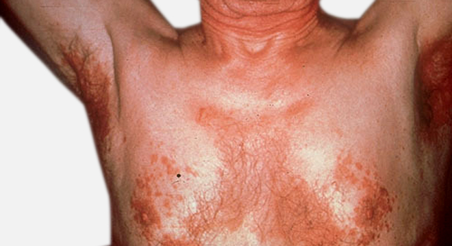 Seborrhoische Dermatitis: Art und Lokalisation des Ekzems helfen zur Diagnose