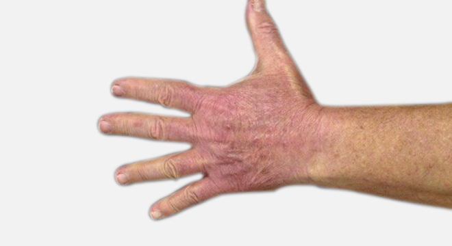 Sonnenallergie: Abwehrreaktion des Immunsystems verursacht durch Sonnenlicht