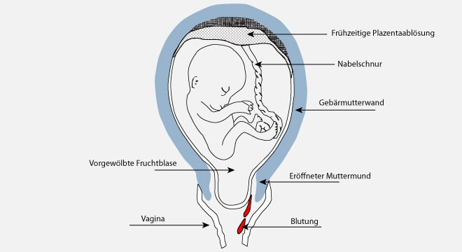 Fehlgeburt: Fötus im Uterus