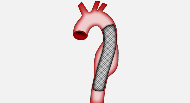 Aortenaneurysma: Einsetzen von künstlichen Prothesen