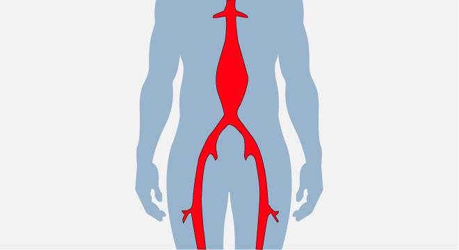 Aortenaneurysma: Meist wird ein Anyeurysma per Zufall entdeckt