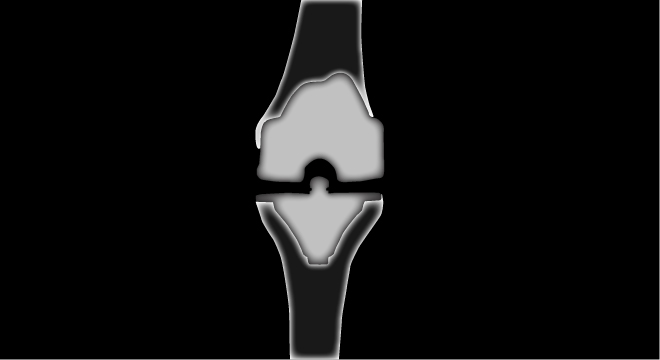 Arthrose: Muskelkräftigung reduziert die Schmerzen