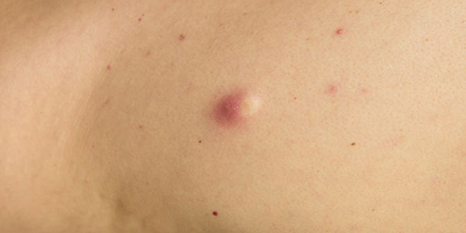 Atherom: Gutartiger Weichteiltumor unter der Haut