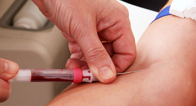 HIV-Test: Bluttest zum Nachweis von Antikörpern auf das HI-Virus