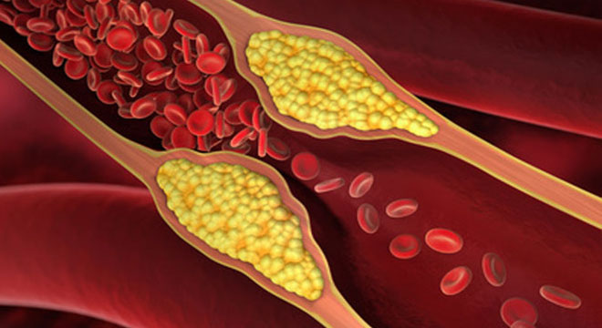Blutfettwerte erhöht: Cholesterinablagerungen in Gefässen