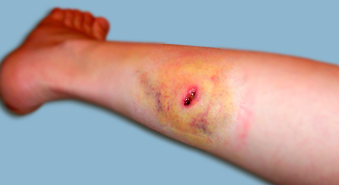 Blutvergiftung, Sepsis: Wunden, Schmerz und Schwellung