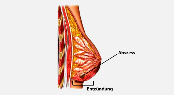 Brustentzündung: Bakterien oder Milchstau als Ursache
