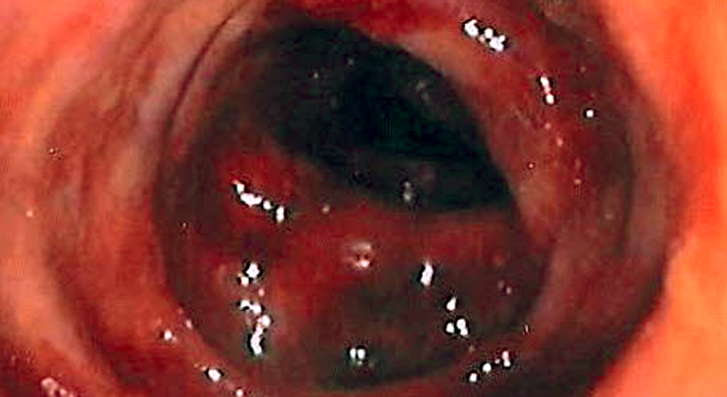 Colitis ulcerosa: Darmspiegelung