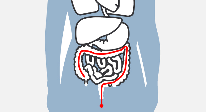 Morbus Crohn: Chronisch entzündliche Darmerkrankung