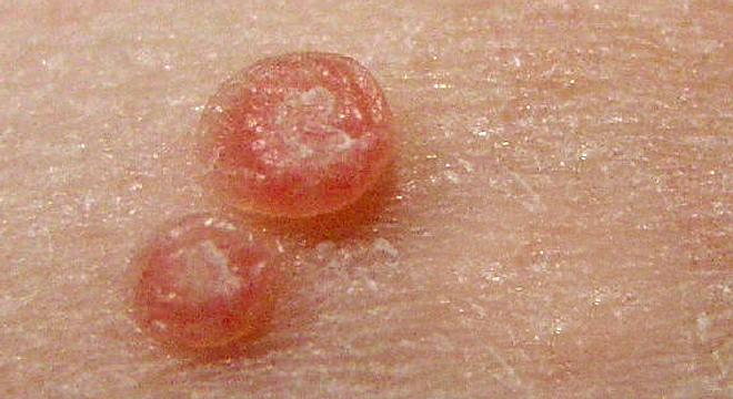 Dellwarzen: Infektion mit einem speziellen Virus