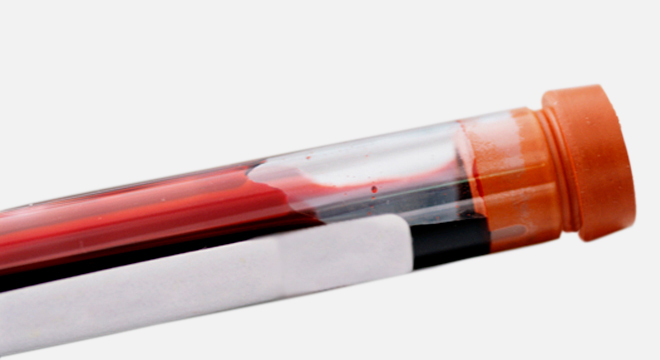 Addison-Syndrom: Hormonbestimmungen und Blutsalze