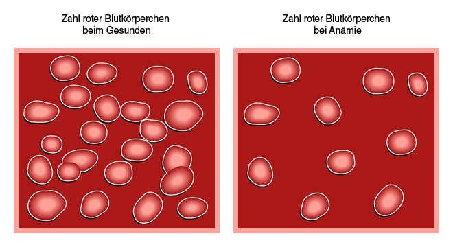 Eisenmangelanämie: Reduzierte Anzahl roter Blutkörperchen