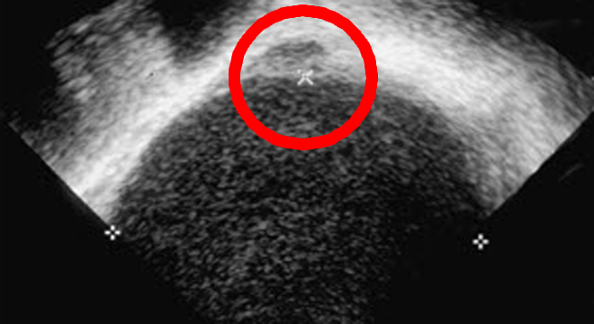 Endometriose: Ultraschall-Aufnahme