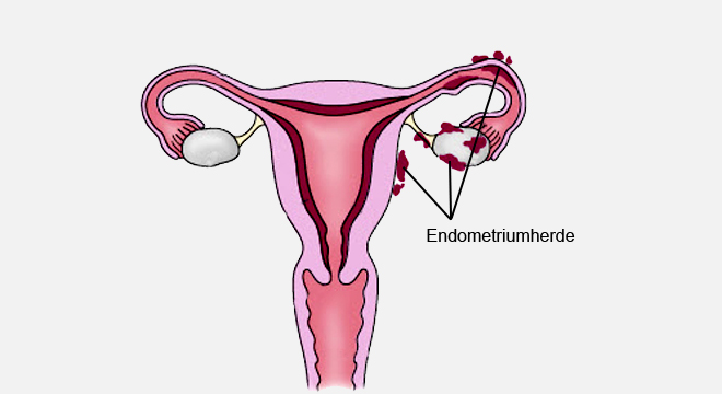 Endometriose: Verschiedene Ursachen möglich