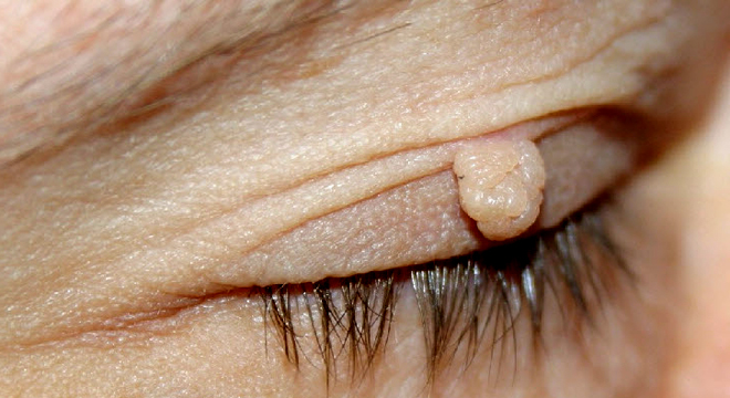 Fibrom: gutartige Geschwulst aus Bindegwebe