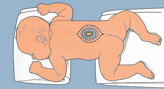 Spina bifida (offener Rücken) durch Folsäuremangel der Mutter in der Schwangerschaft