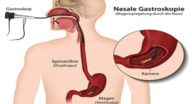 Magenspiegelung oder Gastroskopie: Mit einer Kamera werden die Speiseröhre, der Magen und der Zwölffingerdarm untersucht