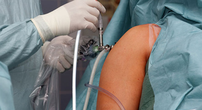 Arthroskopie ist eine Gelenkspiegelung wobei gleichzeitig kleinere Schäden behoben werden können