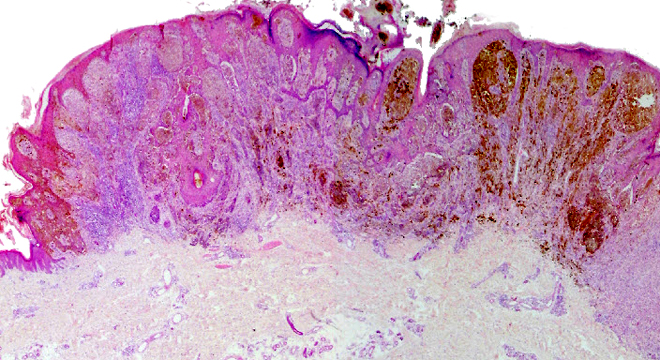 Hautkrebs Schwarz, Melanom: Gewebsentnahme (Biopsie)