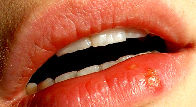 Herpes: Bläschen oder Blattern an den Lippen