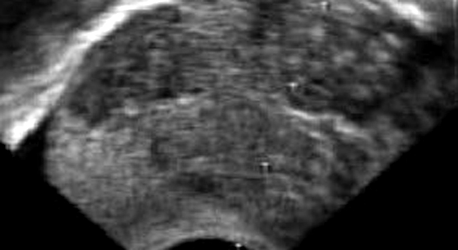 Hodenkrebs: Ultraschalluntersuchung