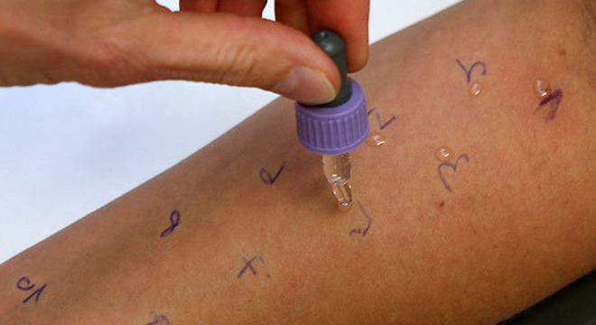 Heuschnupfen: Hauttests bringen die Allergie an den Tag
