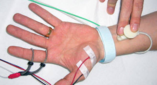 Karpaltunnelsyndrom: Messung der Reizleitung des Nerves