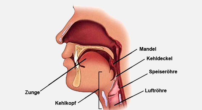 Epiglottitis: Lebensbedrohliche Infektion des Kehldeckels