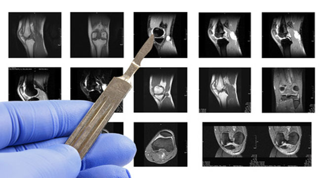 Meniskusläsionen: Röntgen oder MRI des Knies