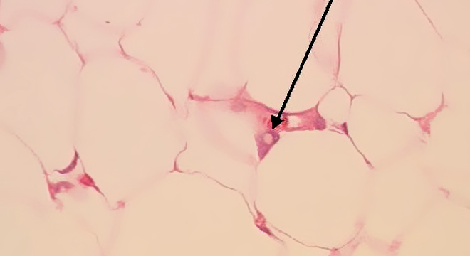 Lipom: Nach Entfernung histologische Untersuchung