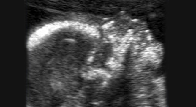 Lippen-Kiefer-Gaumenspalte: Ultraschalluntersuchung