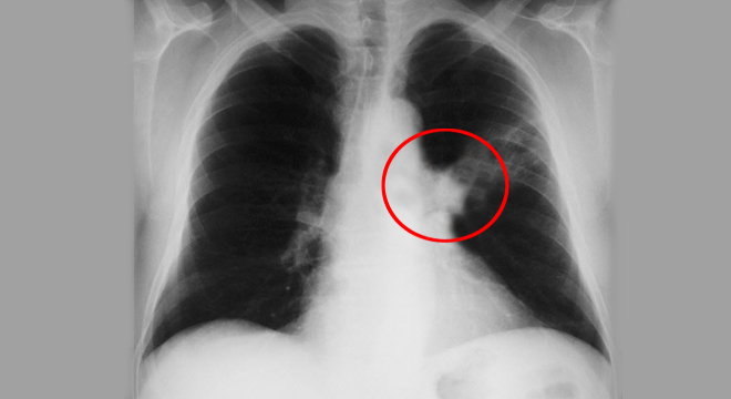 Lungenkrebs, Bronchialkrebs