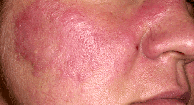 Lupus erythematodes: chronisch entzündliche Autoimmunerkrankung mit Hauterscheinungen